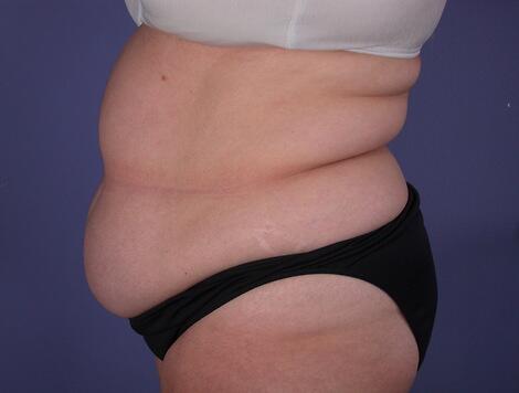 Tummy Tuck Before & After Image