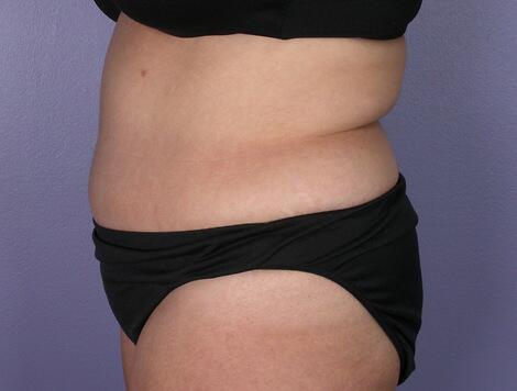 Tummy Tuck Before & After Image