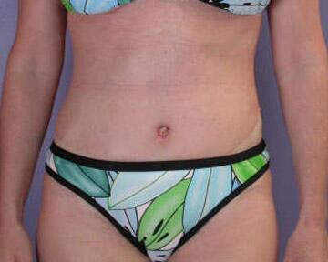 Tummy Tuck Before & After Image