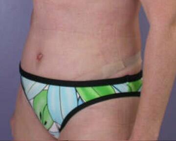 Tummy Tuck Before & After Image