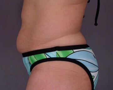 Tummy Tuck Before & After Image