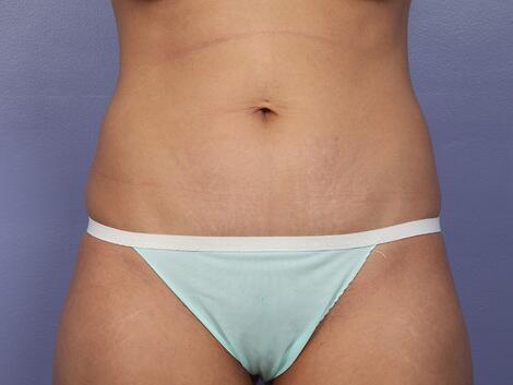 Tummy Tuck Before & After Image