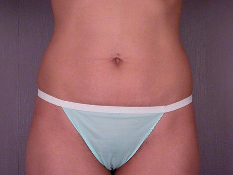 Tummy Tuck Before & After Image