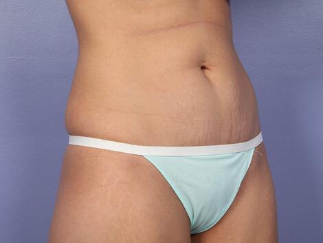 Tummy Tuck Before & After Image