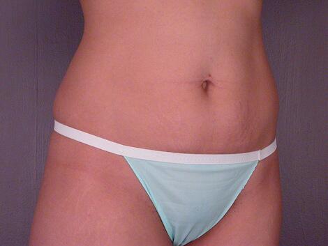 Tummy Tuck Before & After Image