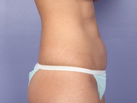 Tummy Tuck Before & After Image