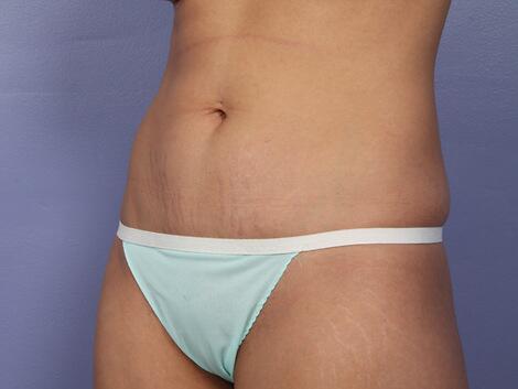 Tummy Tuck Before & After Image