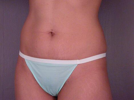 Tummy Tuck Before & After Image