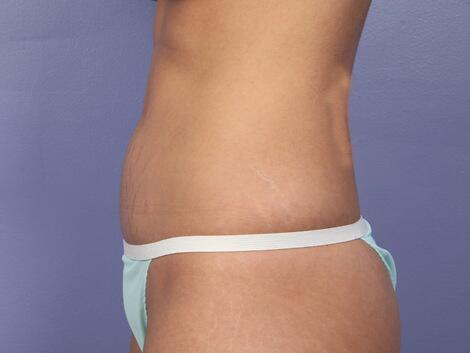 Tummy Tuck Before & After Image