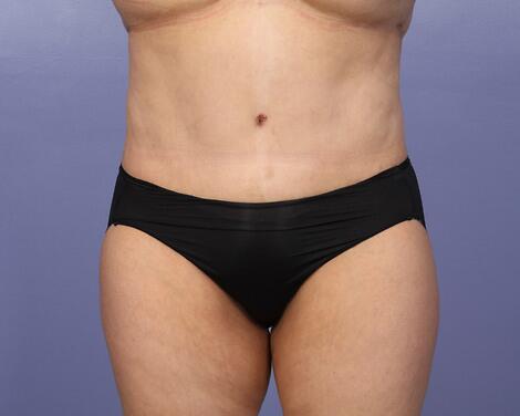 Tummy Tuck Before & After Image