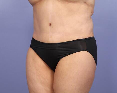 Tummy Tuck Before & After Image