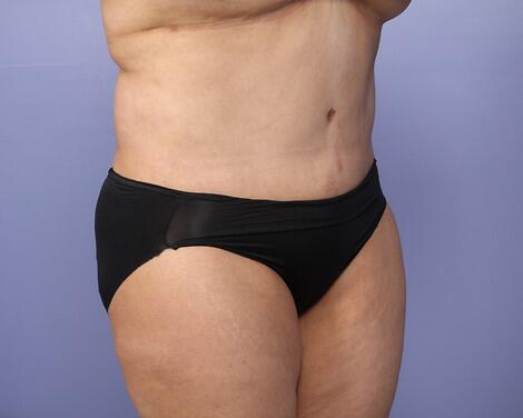 Tummy Tuck Before & After Image