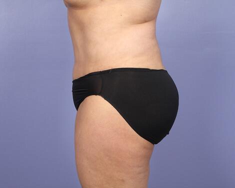 Tummy Tuck Before & After Image