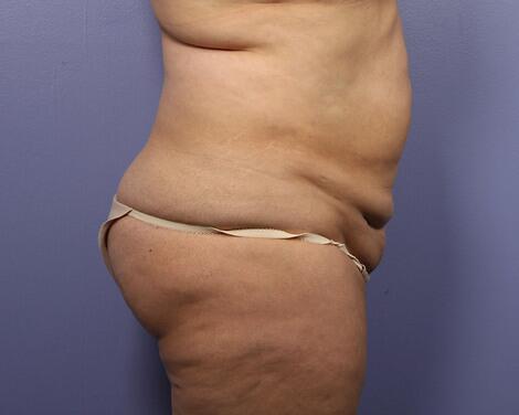 Tummy Tuck Before & After Image