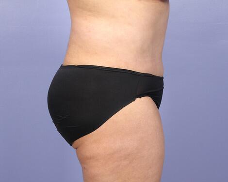 Tummy Tuck Before & After Image