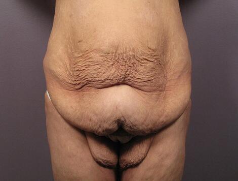 Tummy Tuck Before & After Image