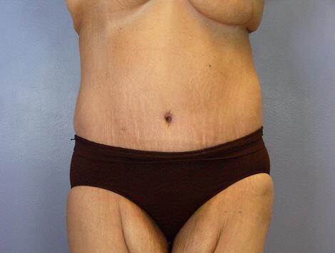 Tummy Tuck Before & After Image