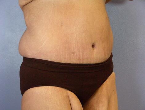 Tummy Tuck Before & After Image