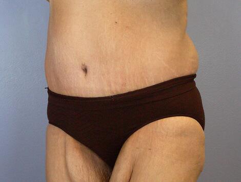 Tummy Tuck Before & After Image