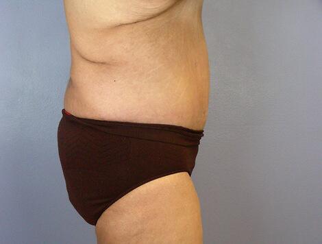 Tummy Tuck Before & After Image