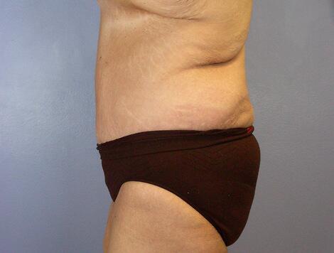 Tummy Tuck Before & After Image