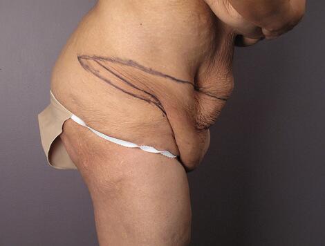 Tummy Tuck Before & After Image