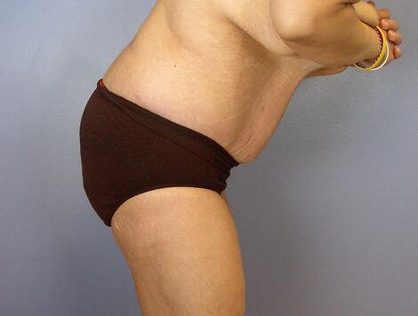 Tummy Tuck Before & After Image