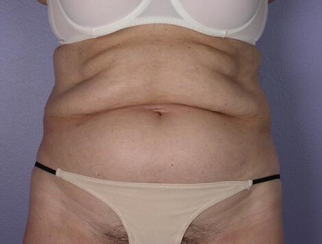 Tummy Tuck Before & After Image