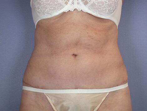 Tummy Tuck Before & After Image