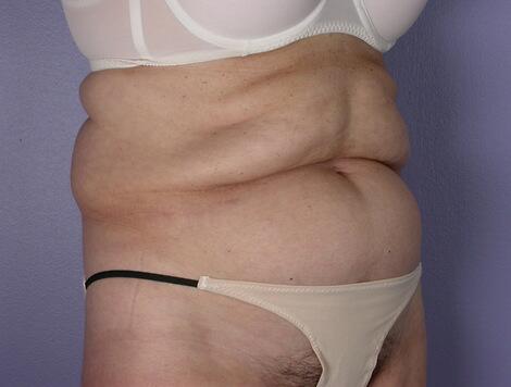 Tummy Tuck Before & After Image