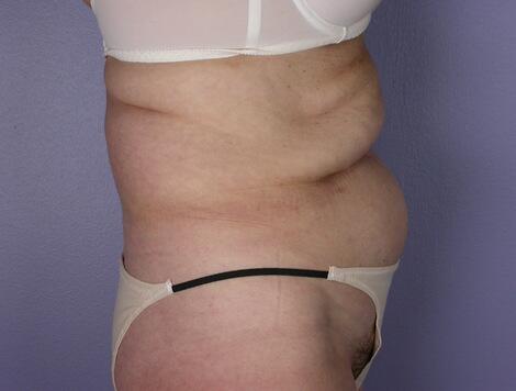 Tummy Tuck Before & After Image