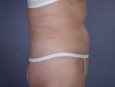 Tummy Tuck Before & After Image