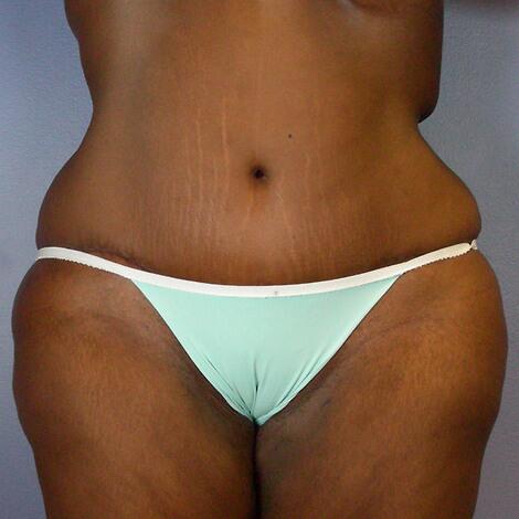 Tummy Tuck Before & After Image