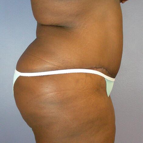 Tummy Tuck Before & After Image