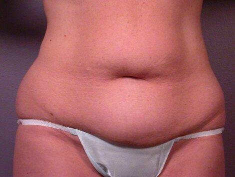 Tummy Tuck Before & After Image