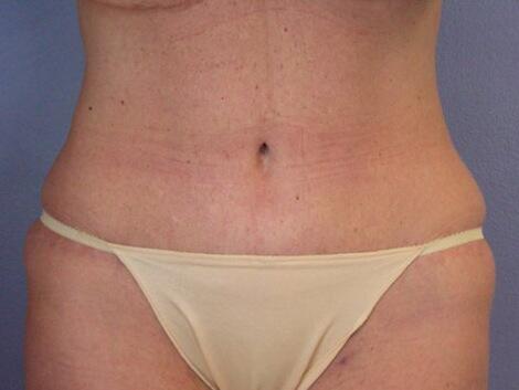 Tummy Tuck Before & After Image