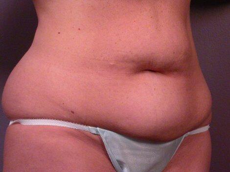 Tummy Tuck Before & After Image