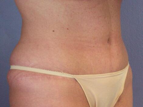 Tummy Tuck Before & After Image