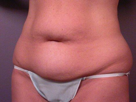 Tummy Tuck Before & After Image