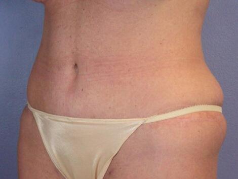 Tummy Tuck Before & After Image