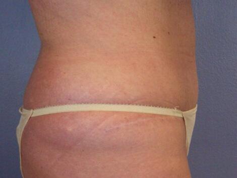 Tummy Tuck Before & After Image