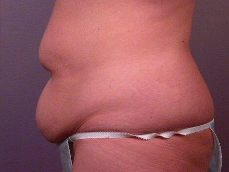 Tummy Tuck Before & After Image