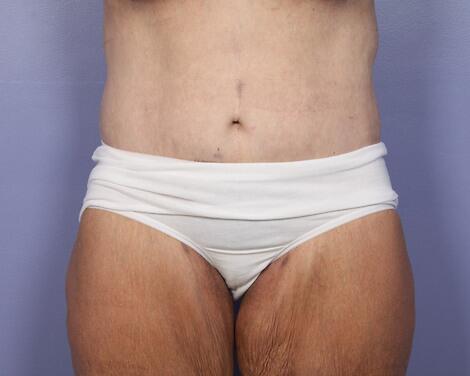 Tummy Tuck Before & After Image