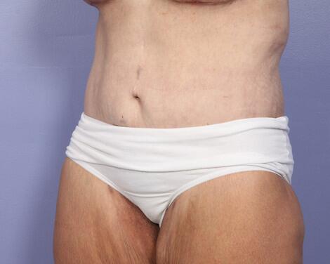 Tummy Tuck Before & After Image