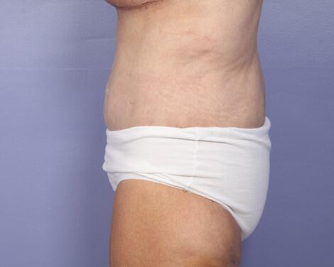 Tummy Tuck Before & After Image