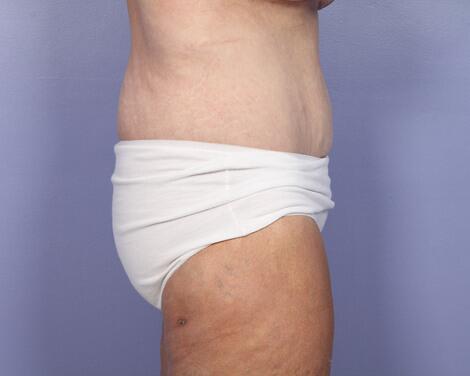 Tummy Tuck Before & After Image