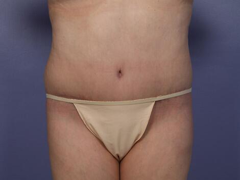 Tummy Tuck Before & After Image