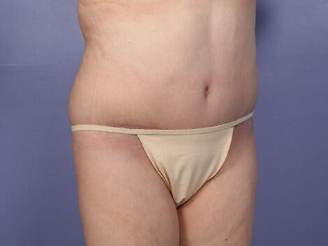 Tummy Tuck Before & After Image