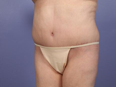 Tummy Tuck Before & After Image