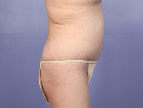 Tummy Tuck Before & After Image